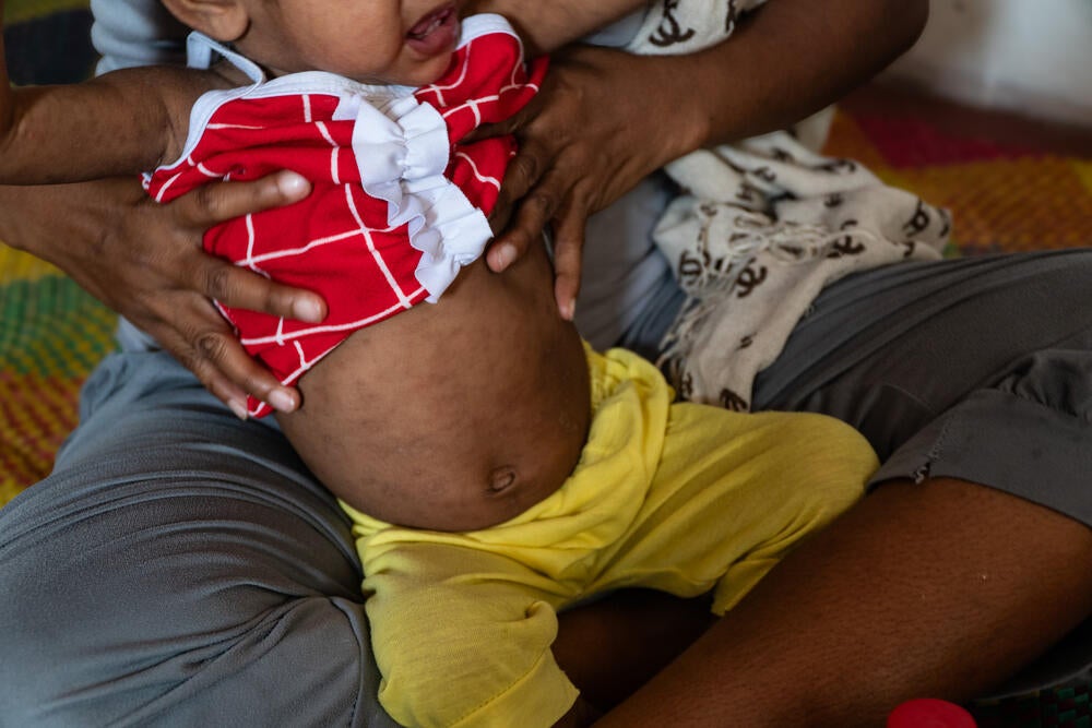 A young boy hit with measles brought to a Women-Friendly Space which served as a quarantine facility during the outbreak. ©UNFPA Philippines/Ferdh Cabrera
